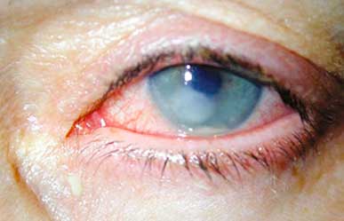Cornea