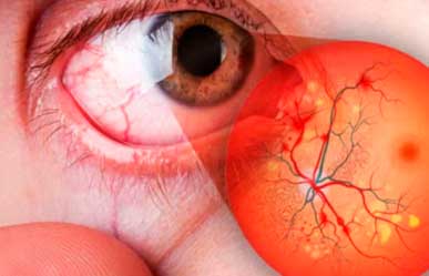 Retina